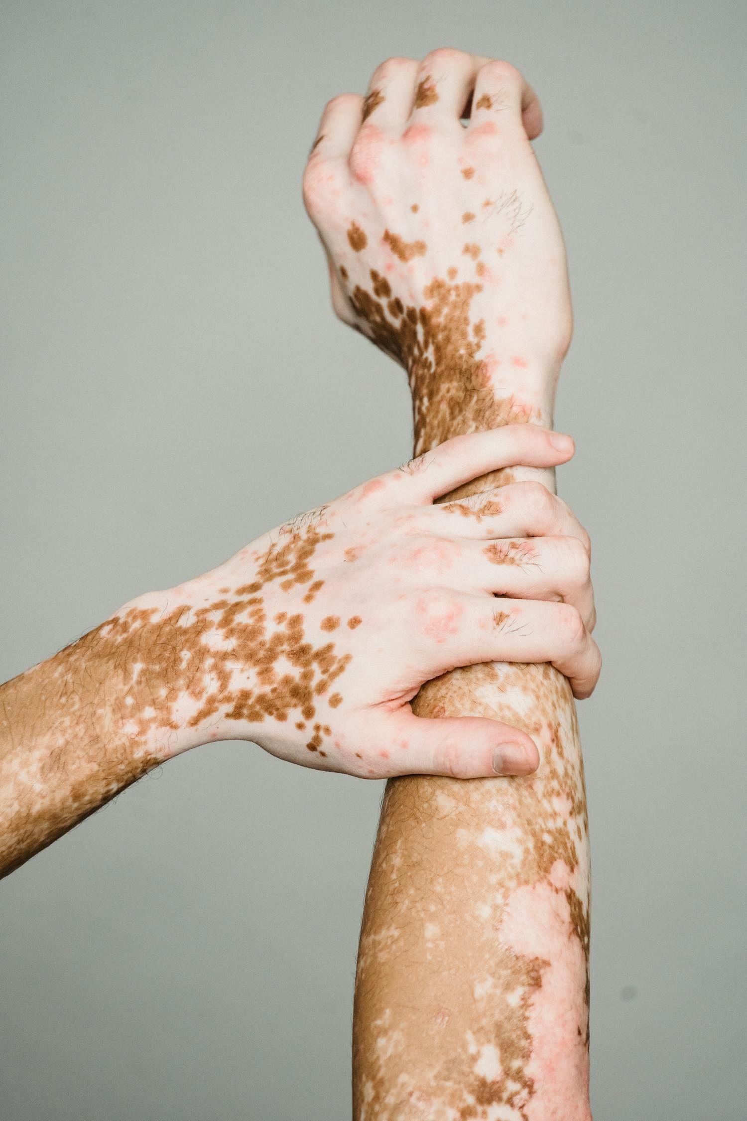 Skin Conditions